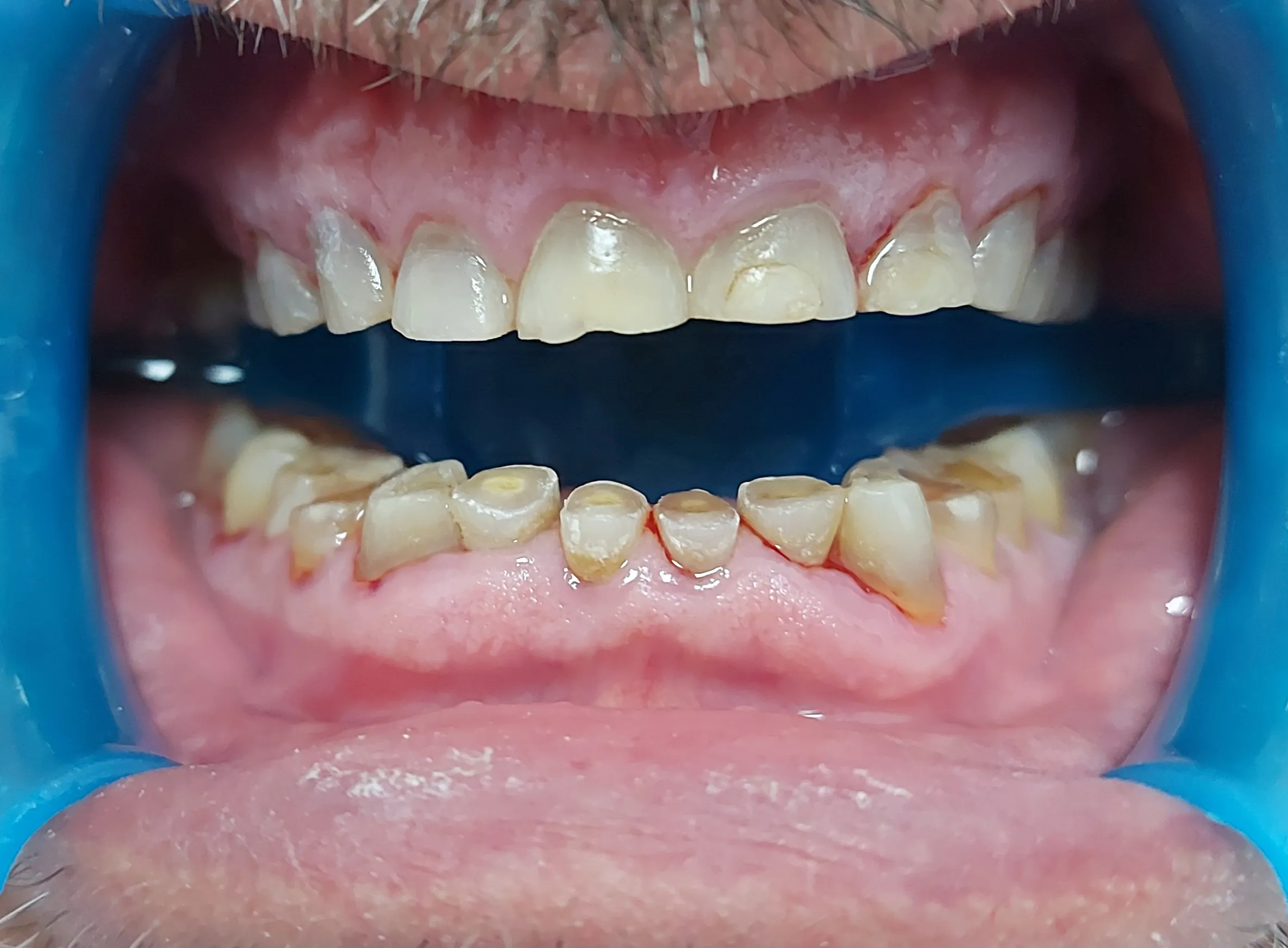 Antes - Coronas y puentes de zirconio