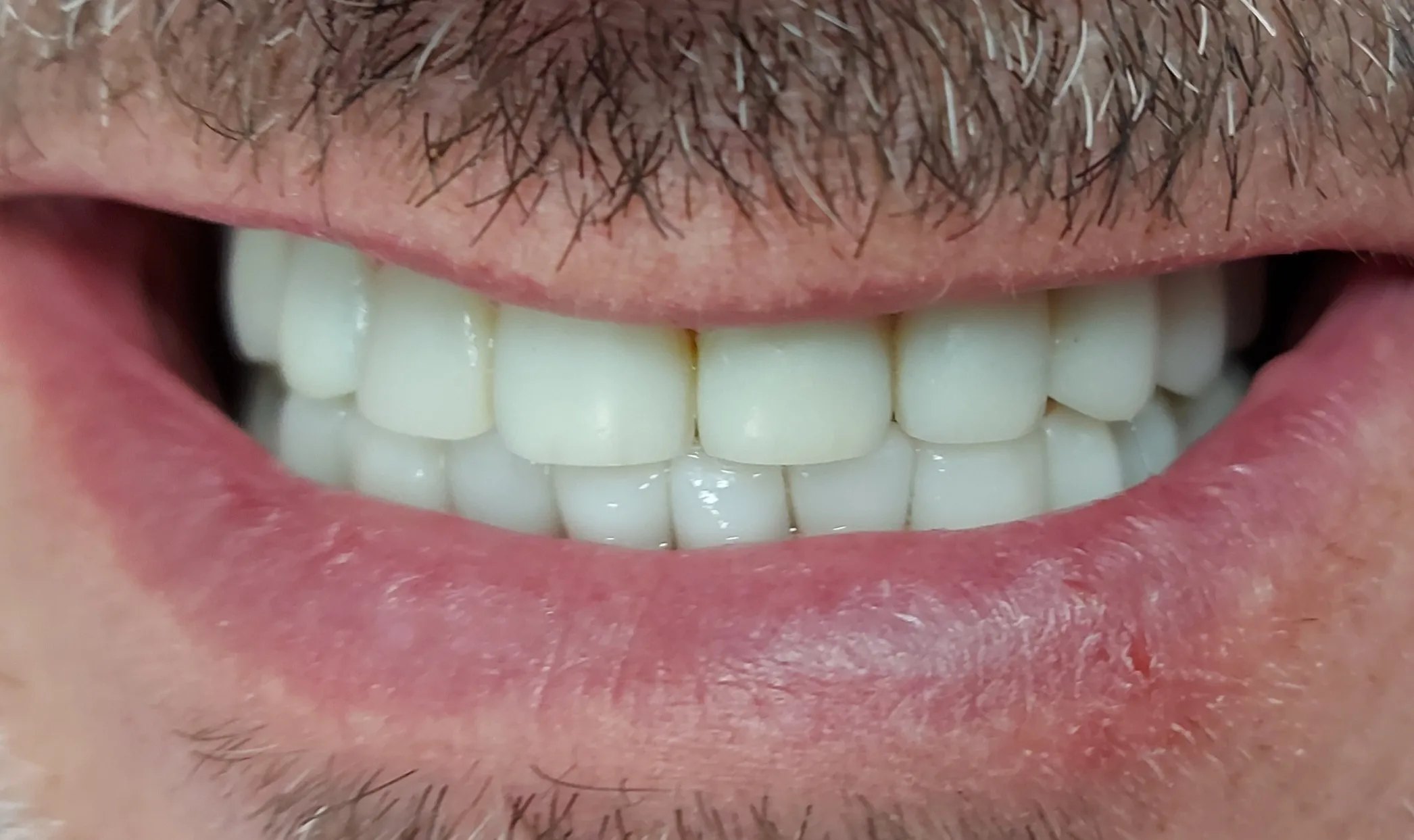 Después - Coronas y puentes de zirconio