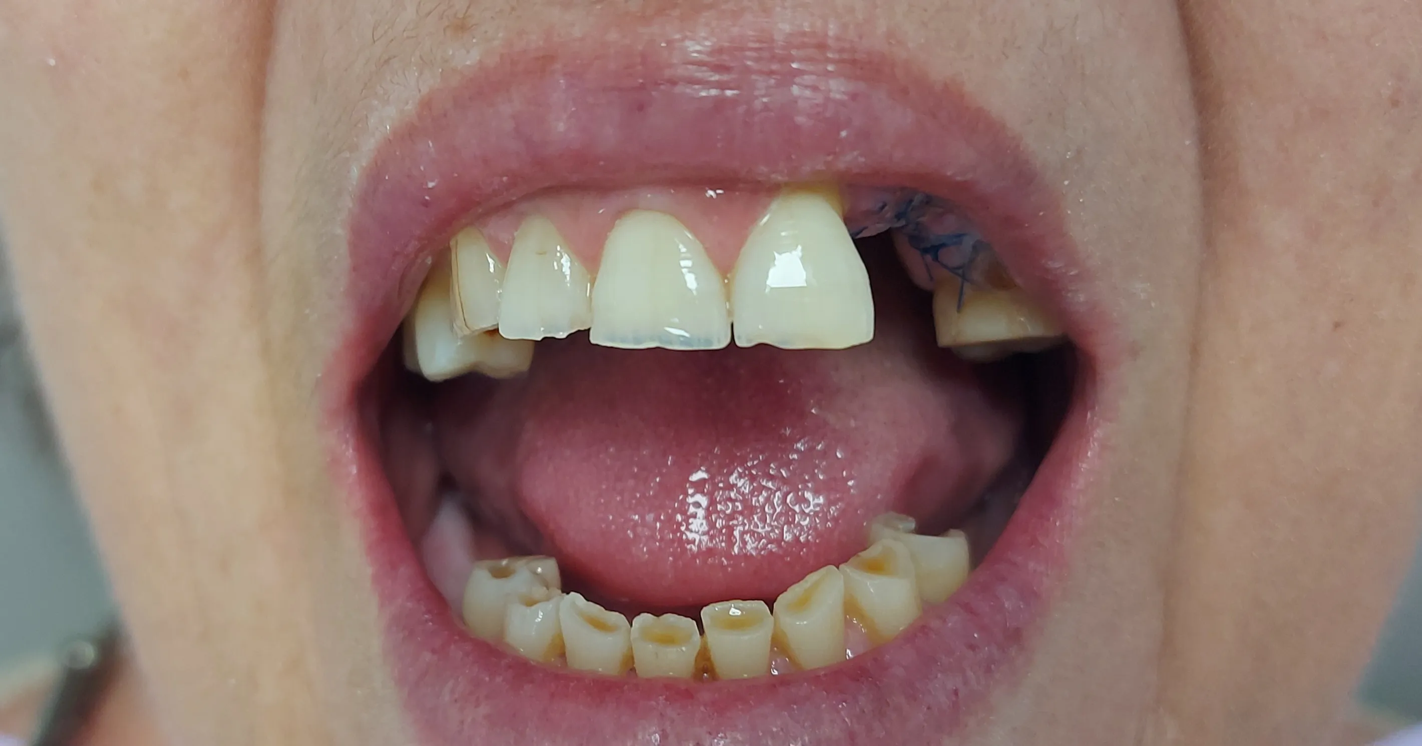 Antes - Implantes y estética