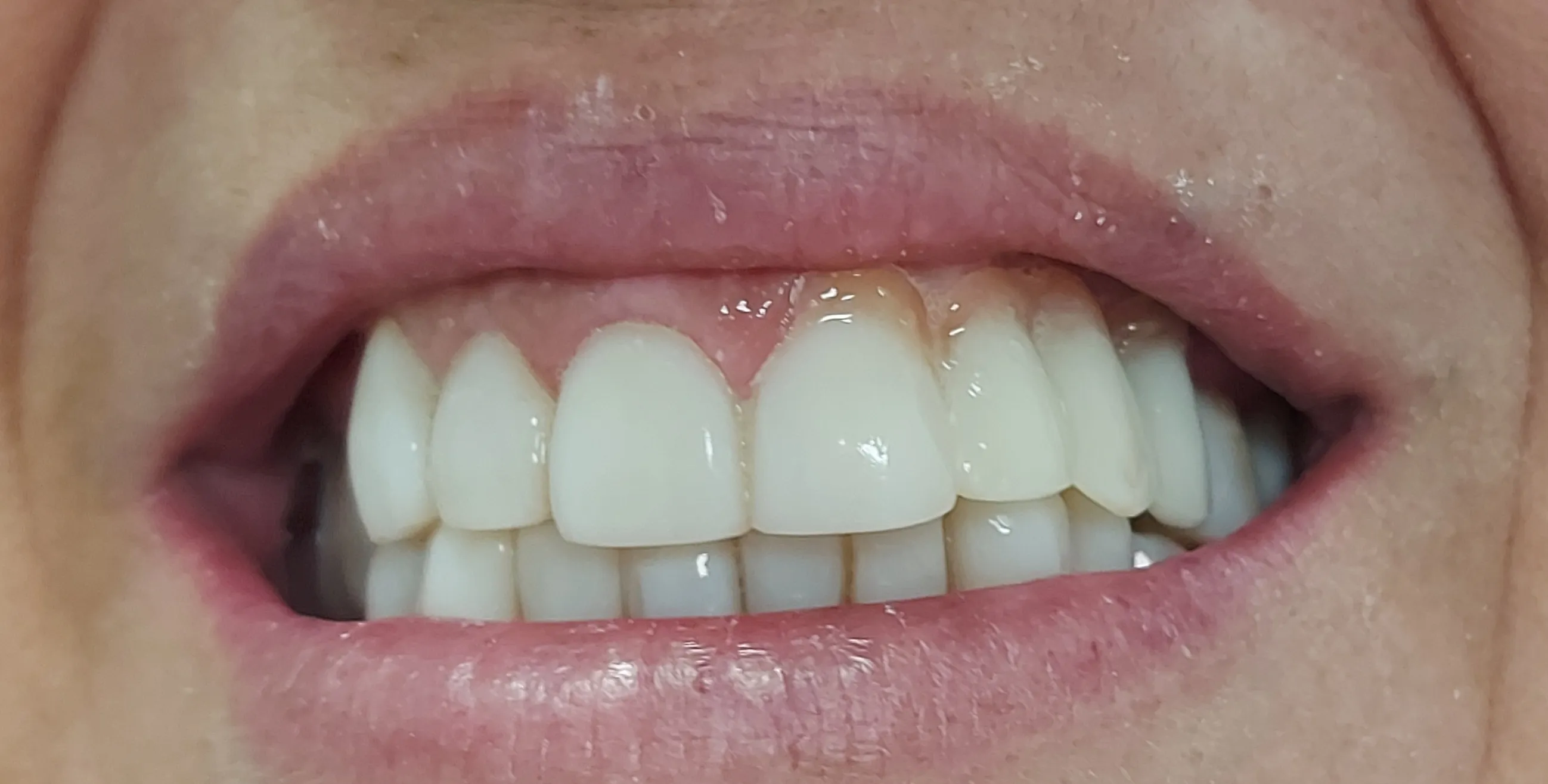 Después - Implantes y estética