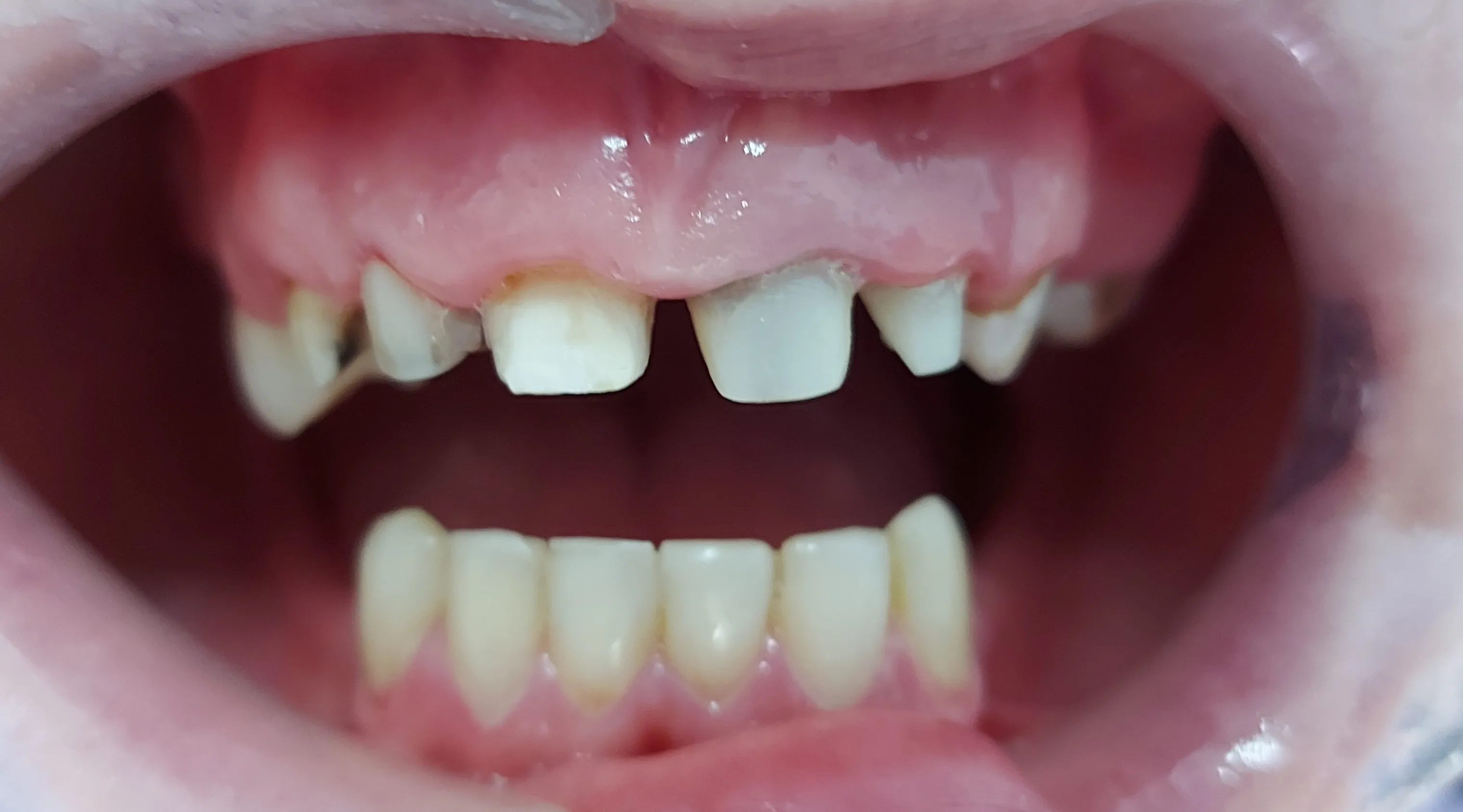 Antes - Coronas de zirconio