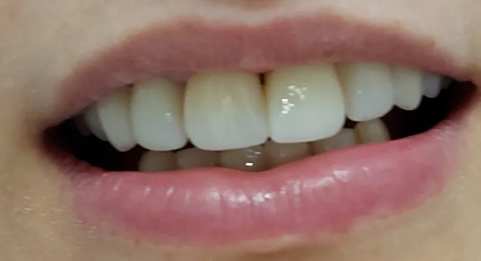 Después - Coronas de zirconio