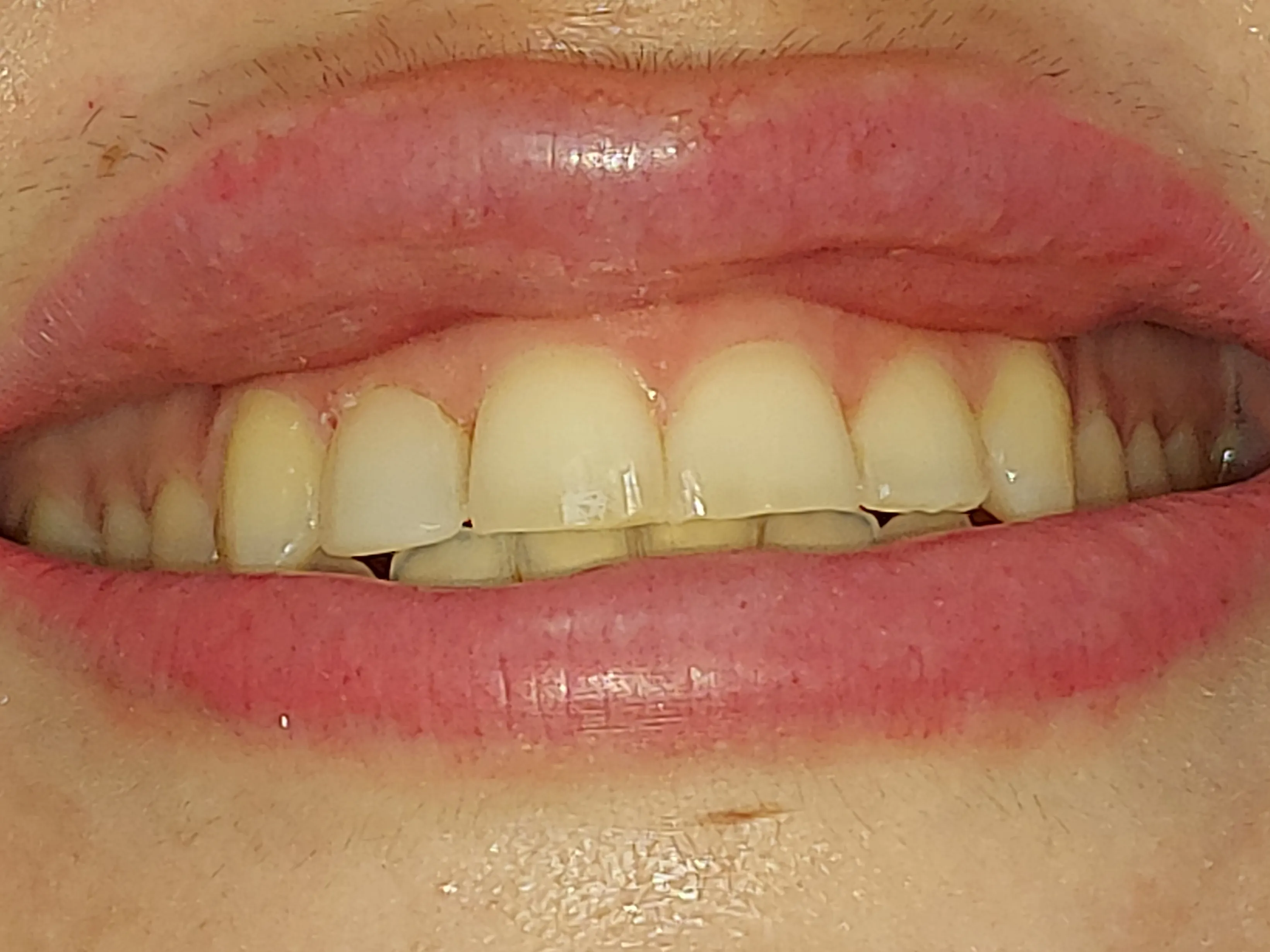 Antes - blanqueamiento y ortodoncia