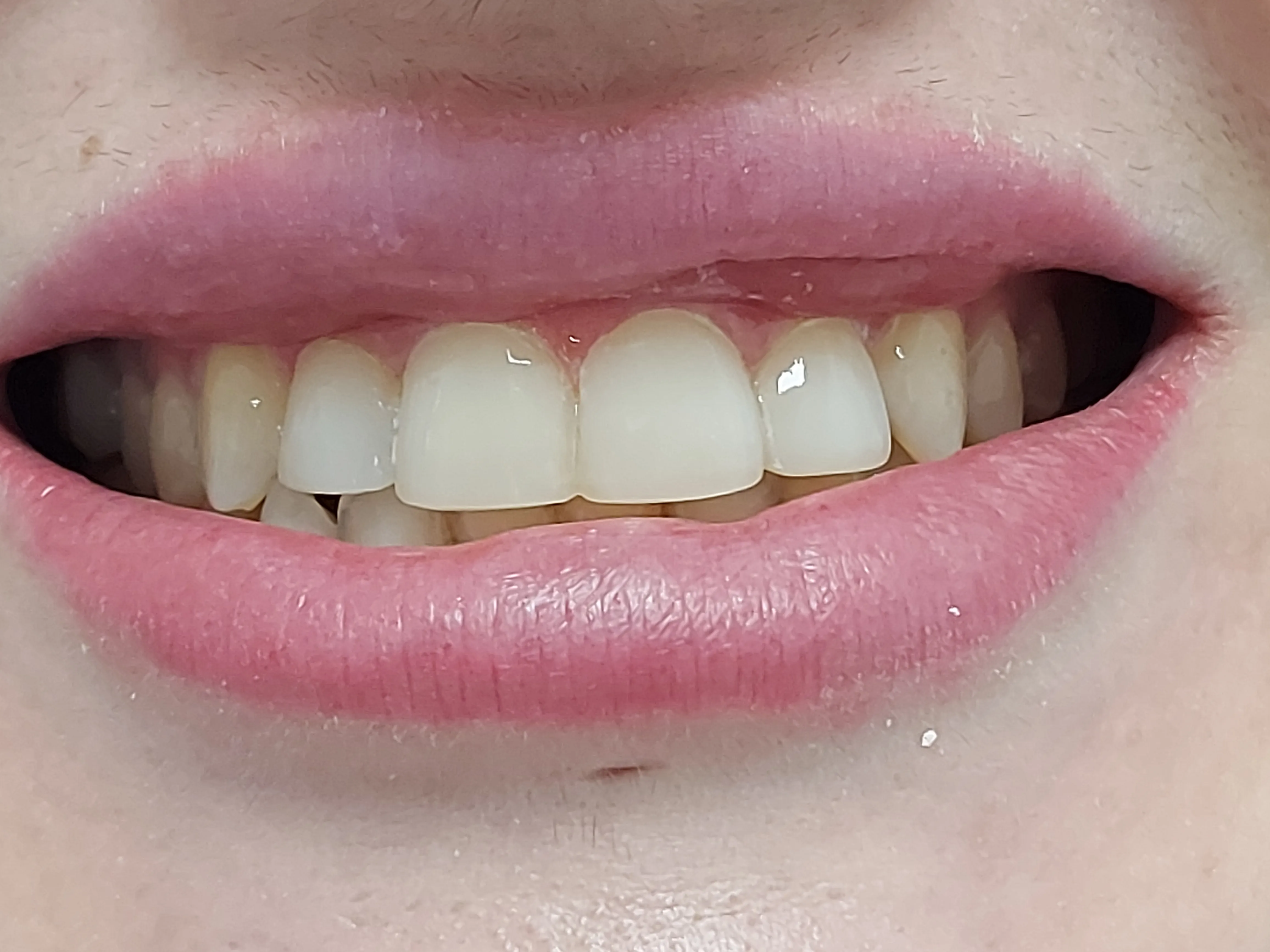 Después - blanqueamiento y ortodoncia