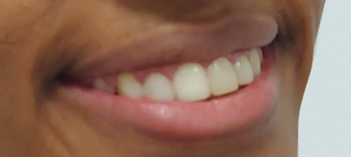 Después - ortodoncia