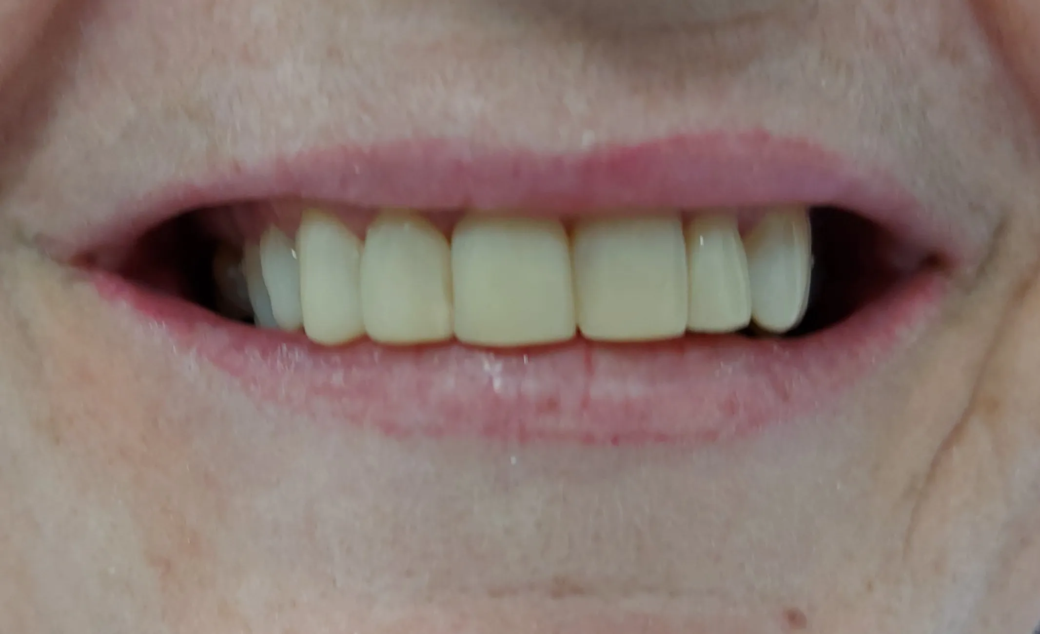 Después - estética